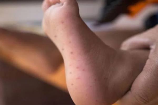 Virus boca, mano, pies: infección viral altamente 